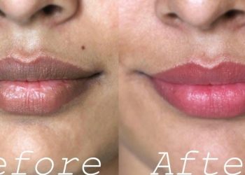 ඔබ තොල් කලු වෙලා නිසා අපහසුතාවයට පත්වුණ කෙනෙක්ද?